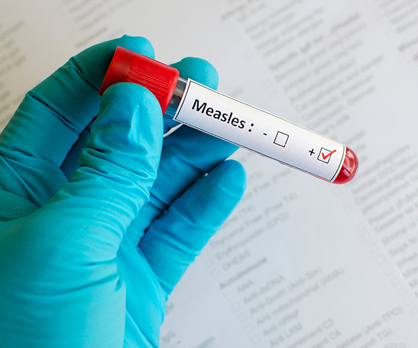 A vile with a positive sample of the measles in it