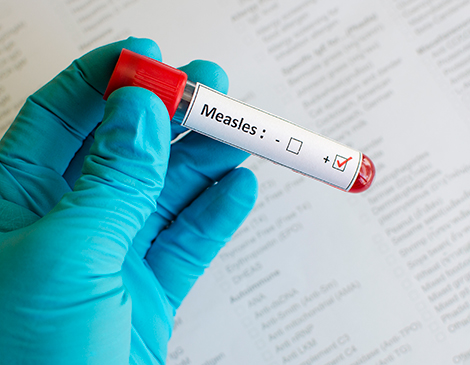 A vile with a positive sample of the measles in it A vile with a positive sample of the measles in it