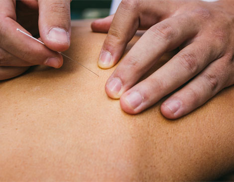 Acupuncture Acupuncture